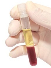 blood_sample_after_centrifugation_plasma_on_top_230